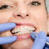Woman having Braces adjusted by orthodontist