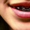Closeup of teeth with braces