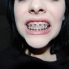girl with braces on teeth